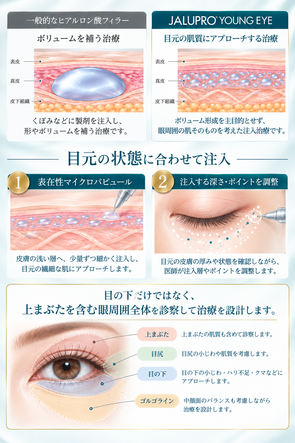 ジャルプロヤングアイとヒアルロン酸注入の違い 注入方法