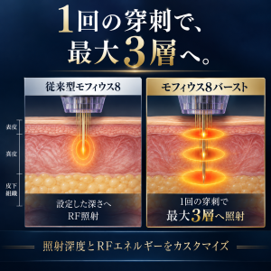 従来型モフィウス8とモフィウス8バーストの照射方式の違い。単一深度照射と最大3層への連続RF照射の比較図