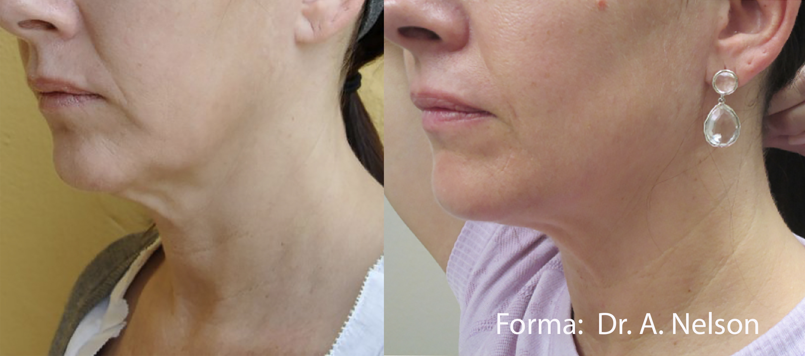 FORMA（フォーマ）のメーカー提供症例写真2。施術前後の比較