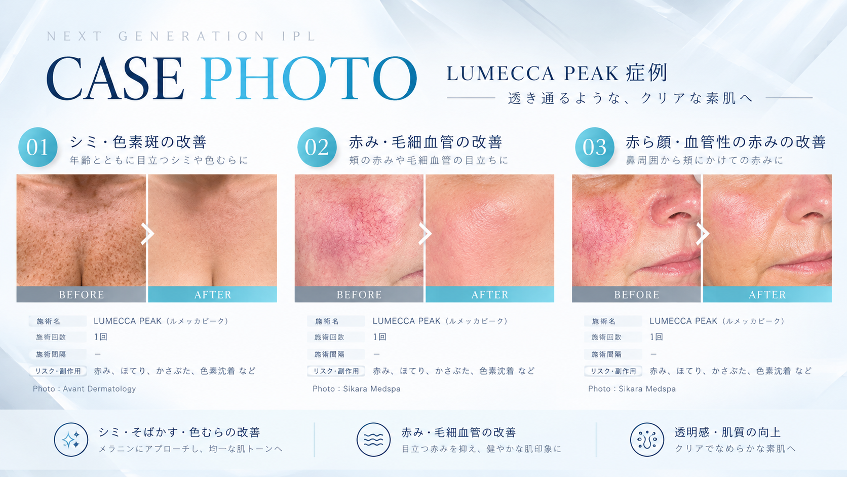 ルメッカピークの症例写真。色素斑や赤みのBefore After