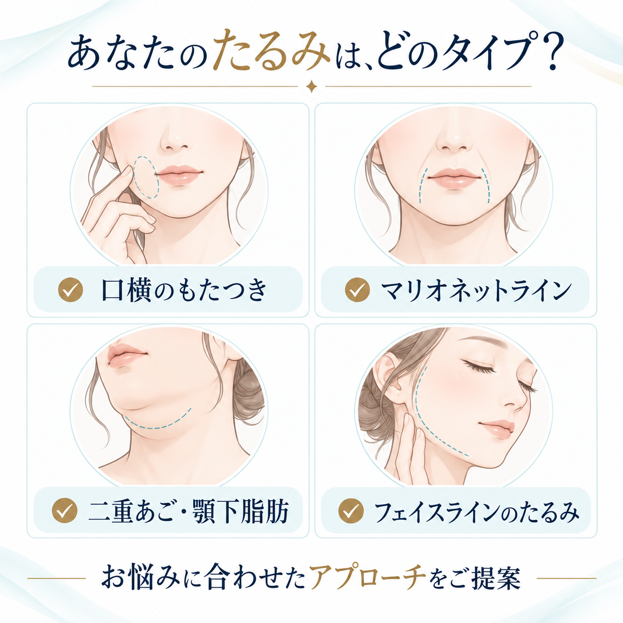 口横のもたつき、マリオネットライン、二重あご・顎下脂肪、フェイスラインのたるみを示したお悩み別のイラスト